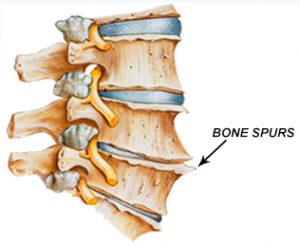 bone spurs