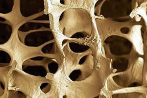 Osteoporosis - Causes - Symptoms - Diagnosis and Treatment